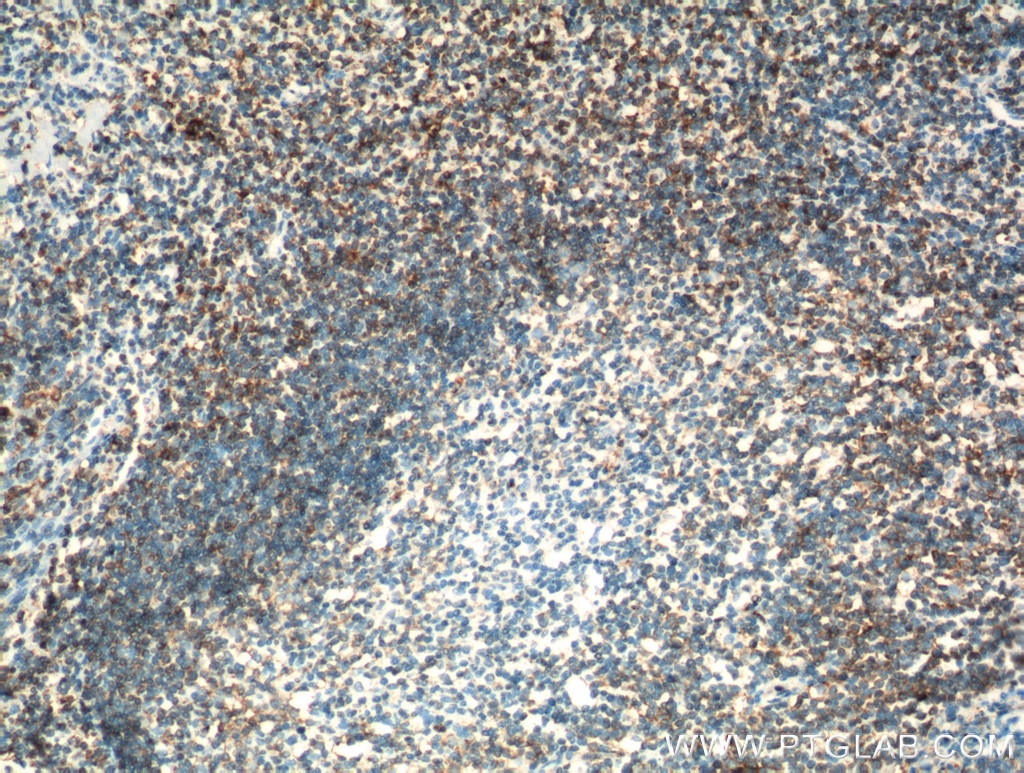 IHC staining of human tonsillitis using 19694-1-AP