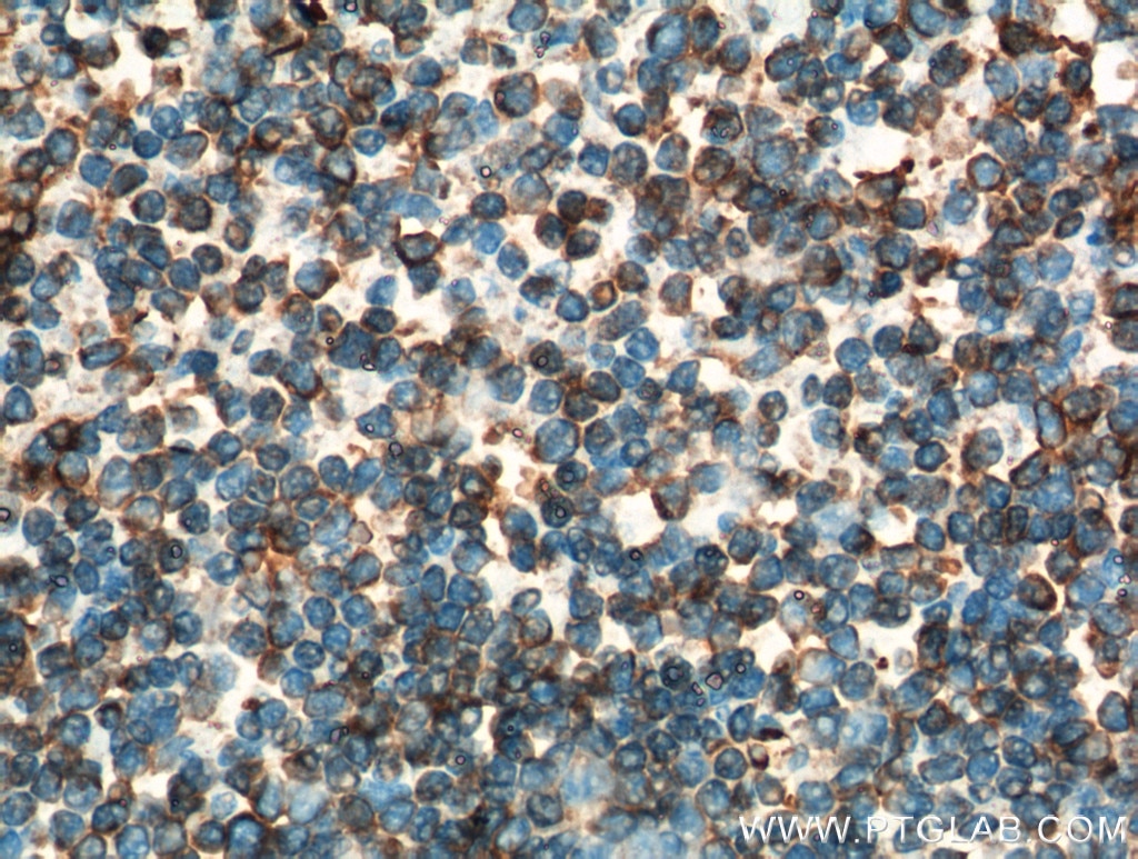 Immunohistochemistry (IHC) staining of human tonsillitis tissue using INPP5D Polyclonal antibody (19694-1-AP)