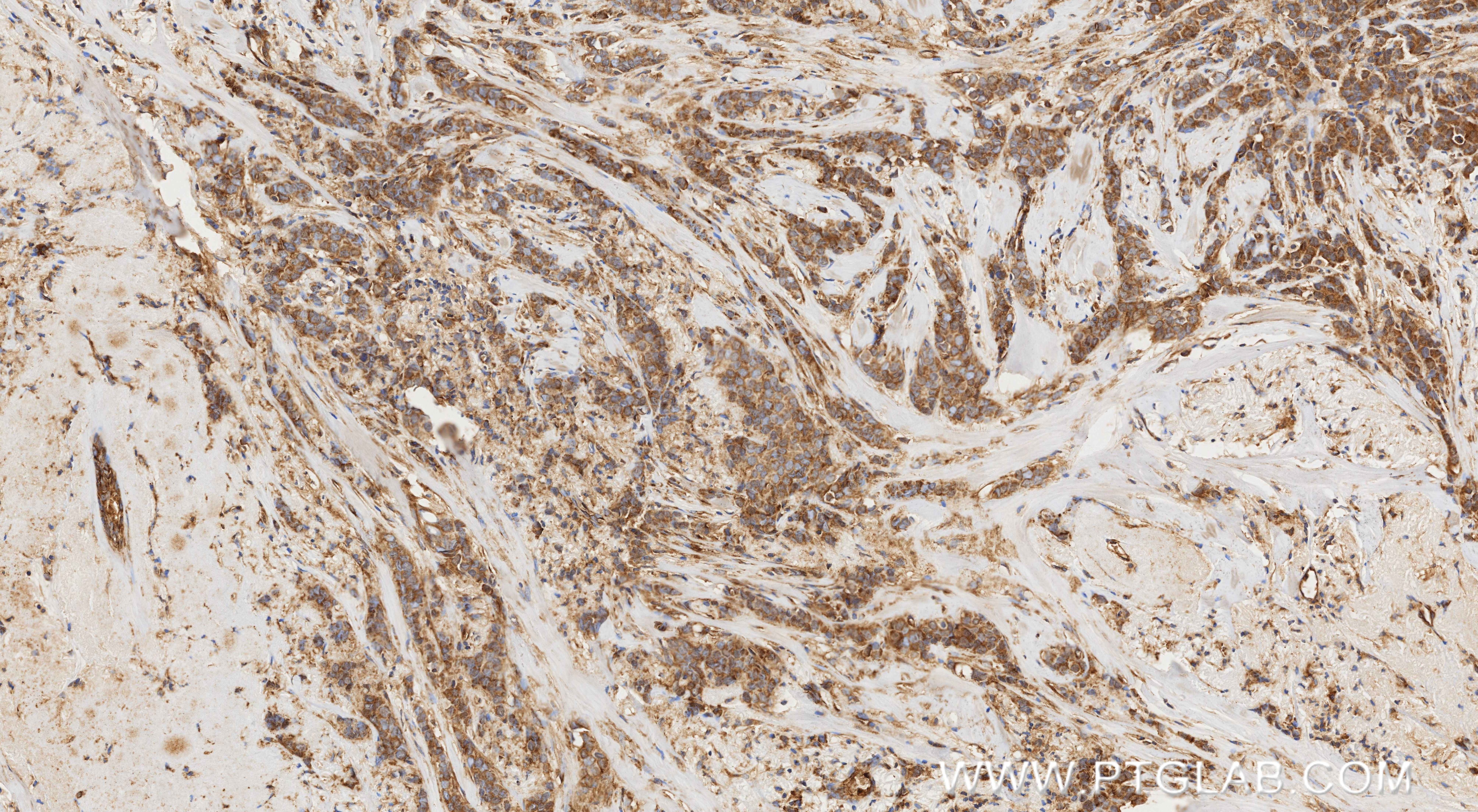 IHC staining of human breast cancer using 87161-1-RR Immunohistochemistry (IHC) staining of human breast cancer tissue using INPPL1 Recombinant monoclonal antibody (87161-1-RR)