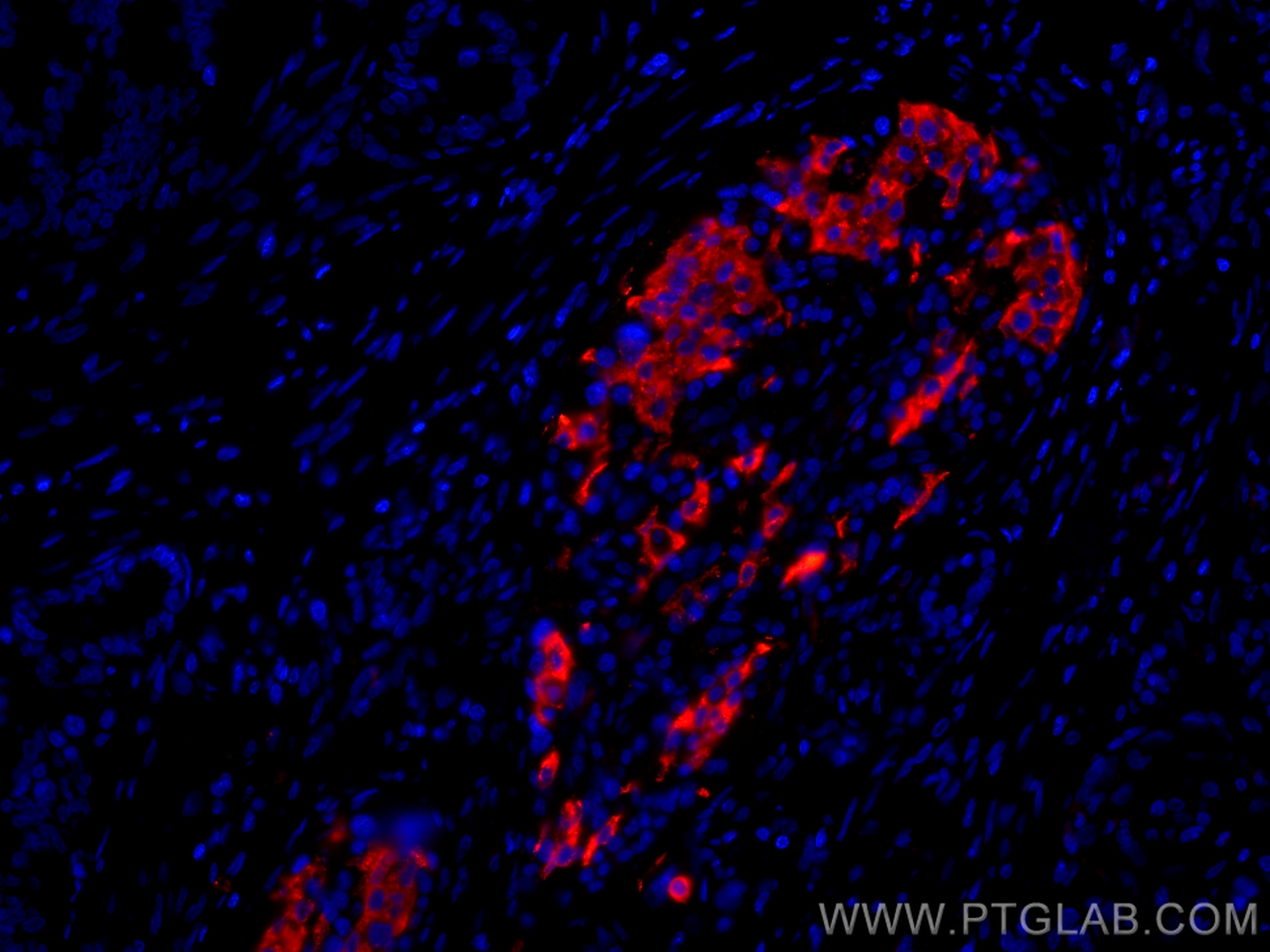 IF Staining of human pancreas cancer using CL594-15848