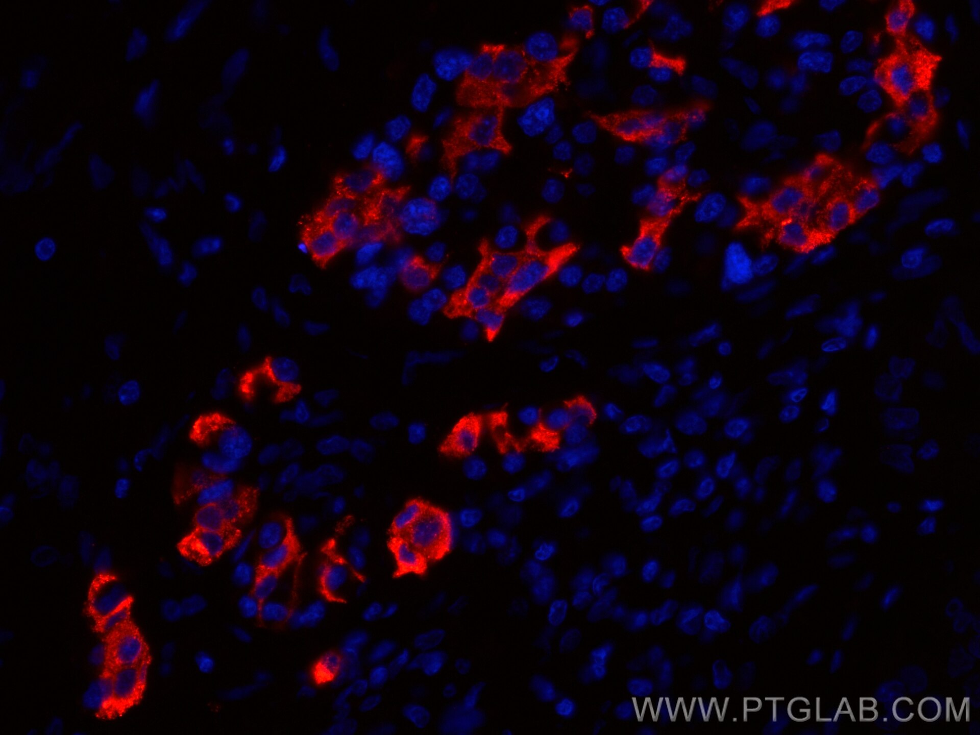 Immunofluorescence (IF) / fluorescent staining of human pancreas cancer tissue using CoraLite®594-conjugated INS Polyclonal antibody (CL594-15848)