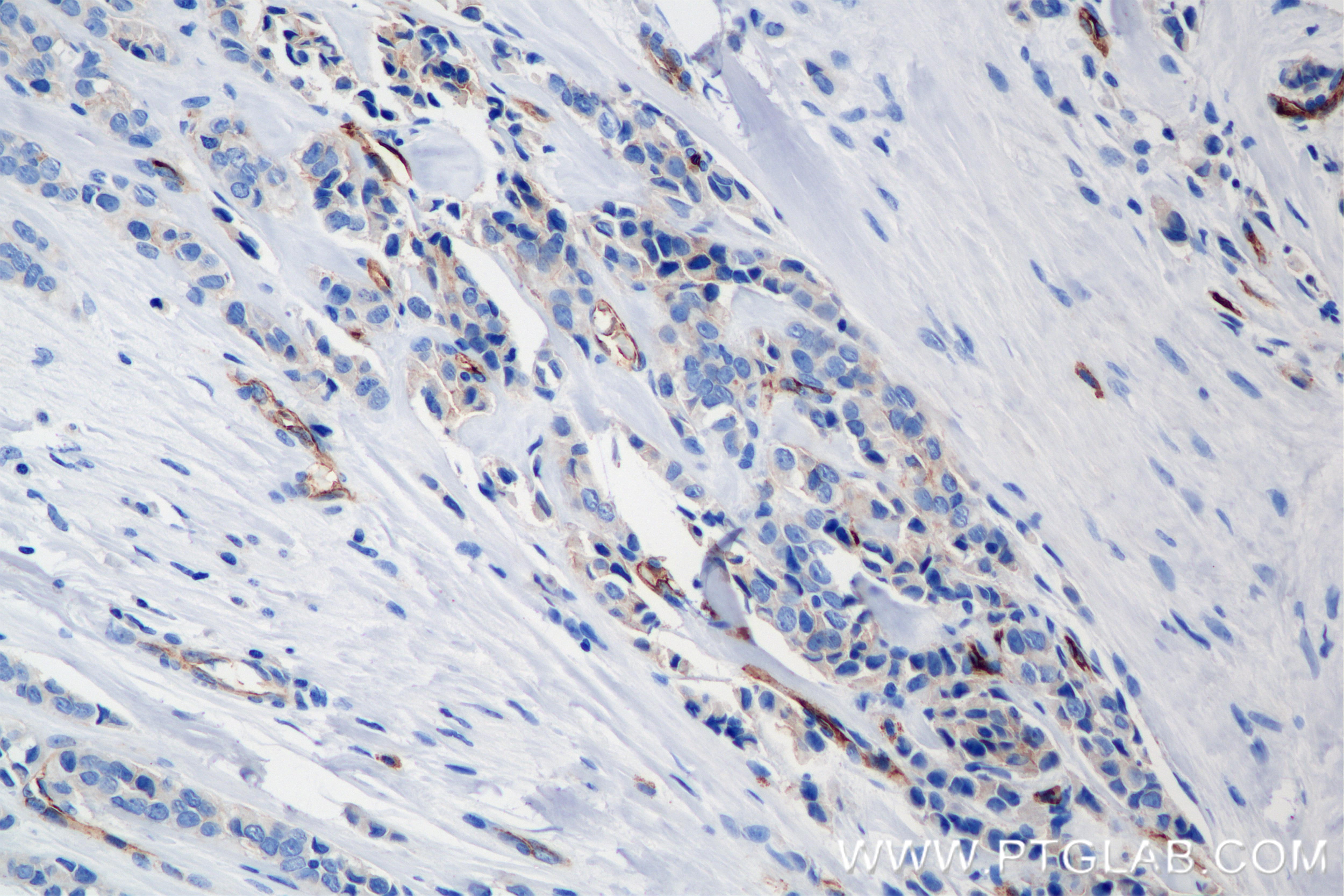 Immunohistochemistry (IHC) staining of human breast cancer tissue using INSR/CD220 Recombinant antibody (84467-2-RR)