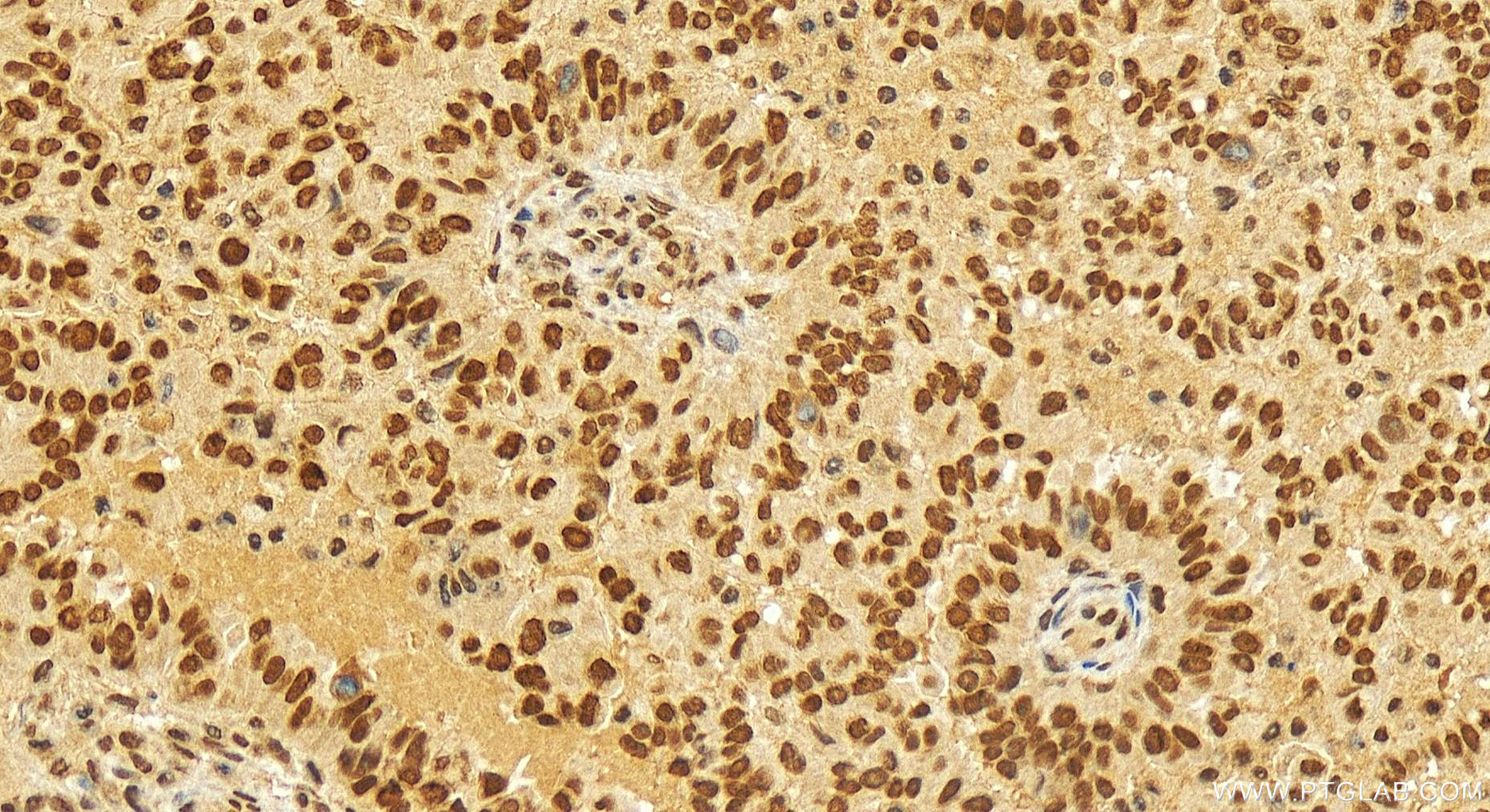 Immunohistochemistry (IHC) staining of human ovary cancer tissue using INTS3 Polyclonal antibody (16620-1-AP)