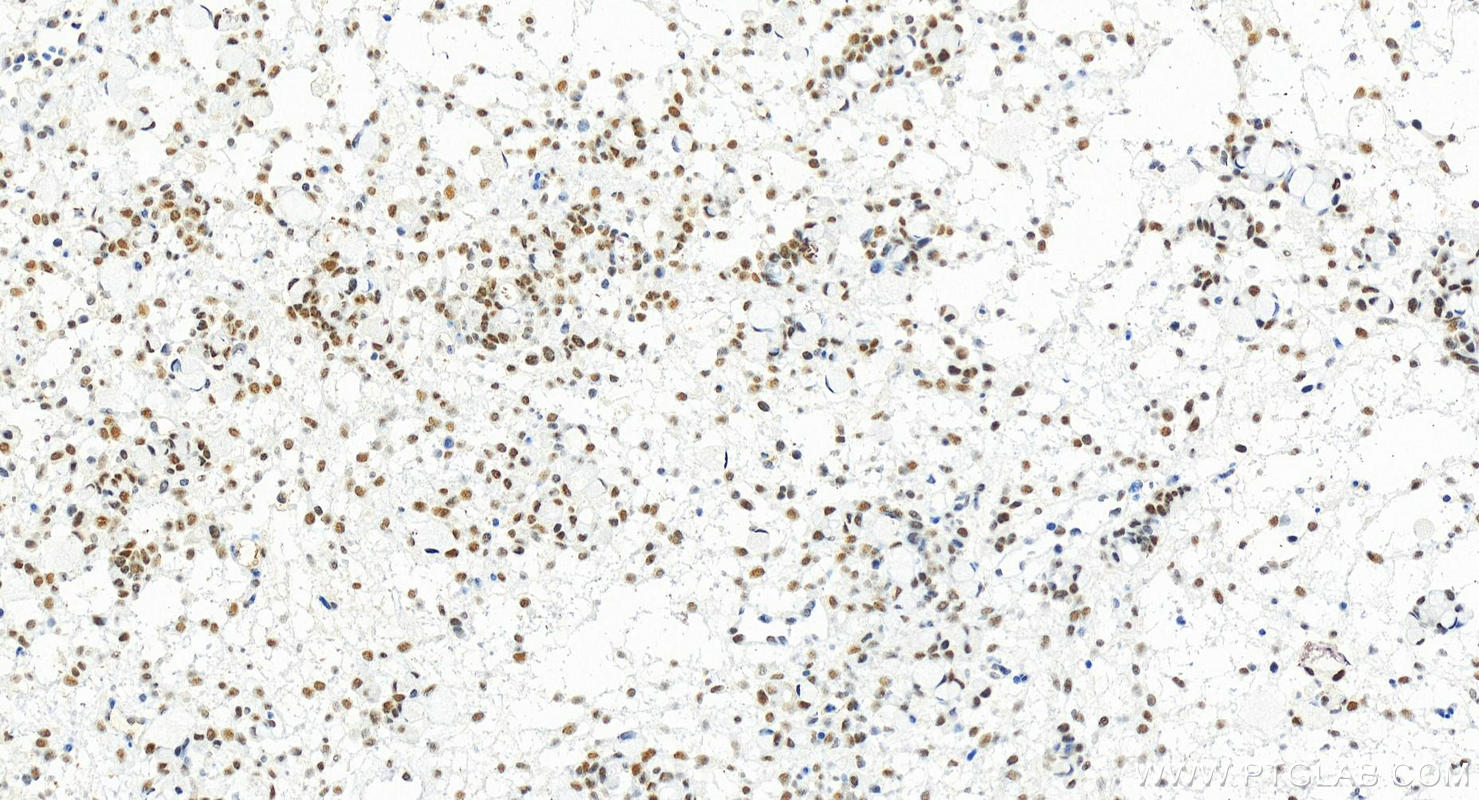 Immunohistochemistry (IHC) staining of human ovary cancer tissue using INTS4 Recombinant antibody (83590-6-RR)