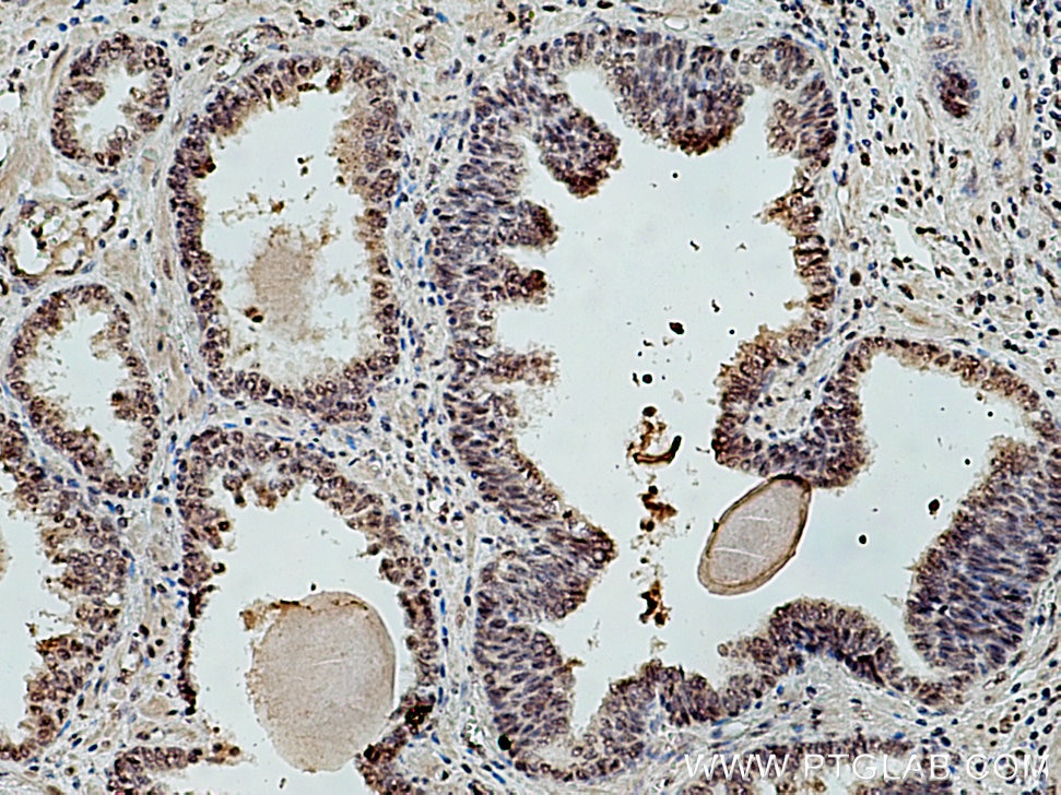 Immunohistochemistry (IHC) staining of human prostate cancer tissue using INTS5 Polyclonal antibody (14069-1-AP)