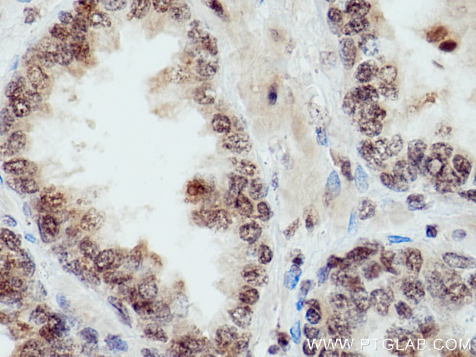 Immunohistochemistry (IHC) staining of human prostate cancer tissue using INTS5 Polyclonal antibody (14069-1-AP)