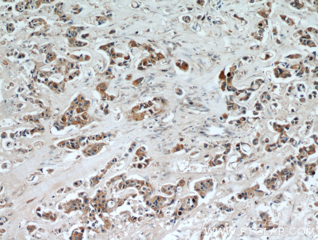 Immunohistochemistry (IHC) staining of human breast cancer tissue using INVS Polyclonal antibody (10585-1-AP)