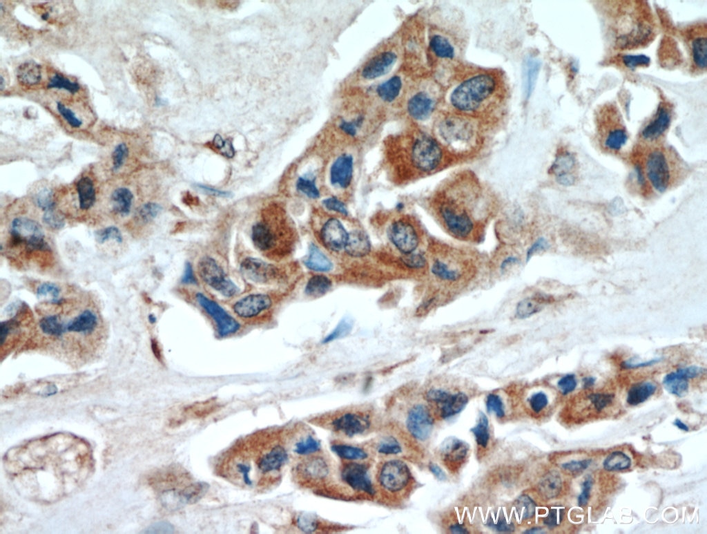 Immunohistochemistry (IHC) staining of human breast cancer tissue using INVS Polyclonal antibody (10585-1-AP)