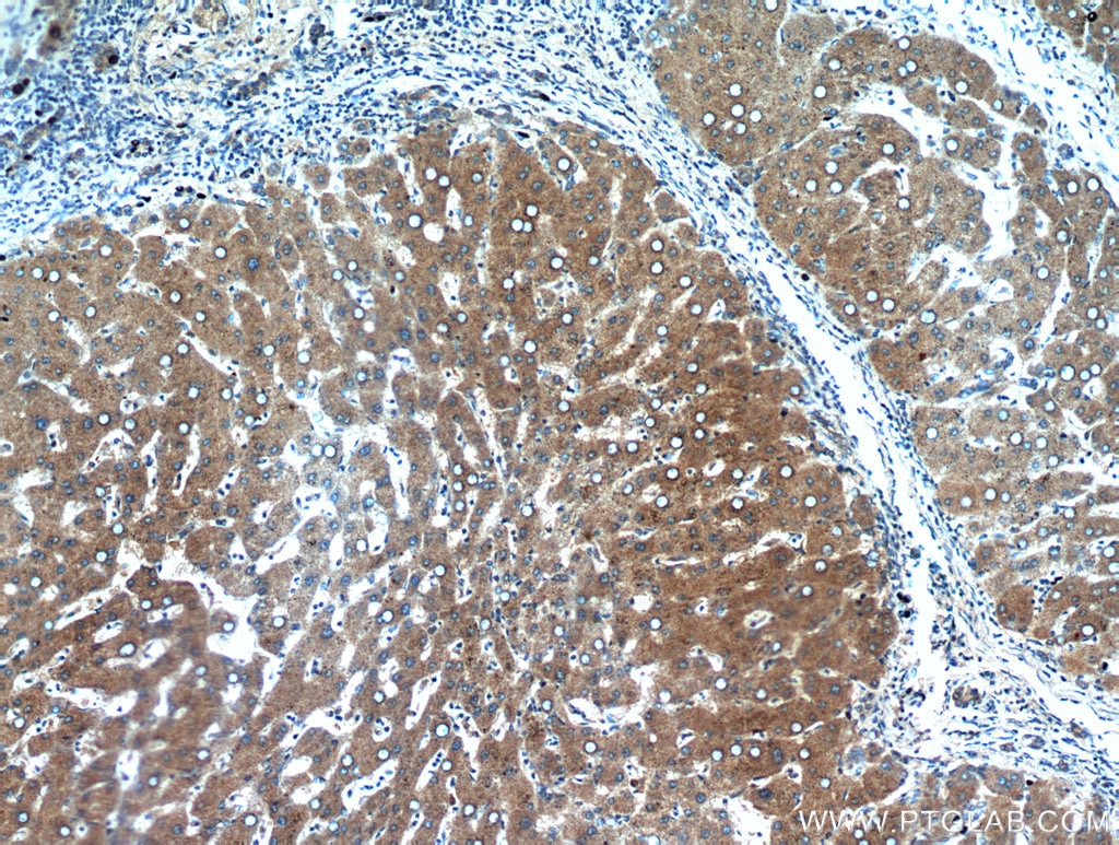 Immunohistochemistry (IHC) staining of human hepatocirrhosis tissue using INVS Polyclonal antibody (10585-1-AP)