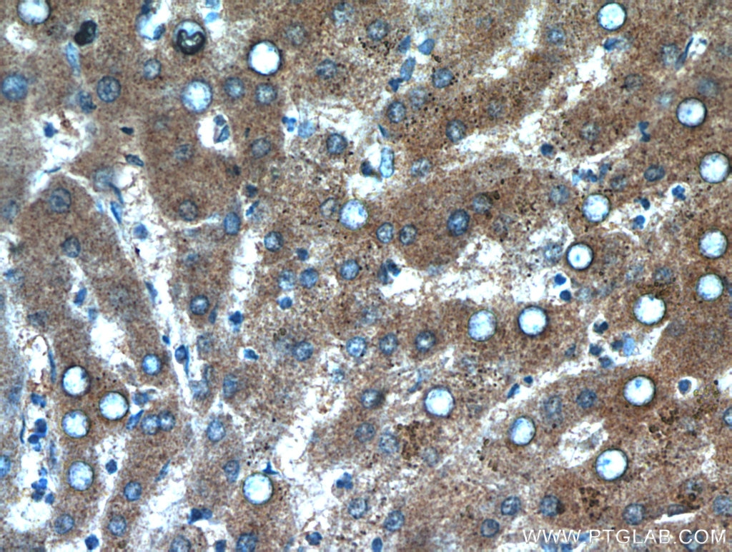 IHC staining of human hepatocirrhosis using 10585-1-AP