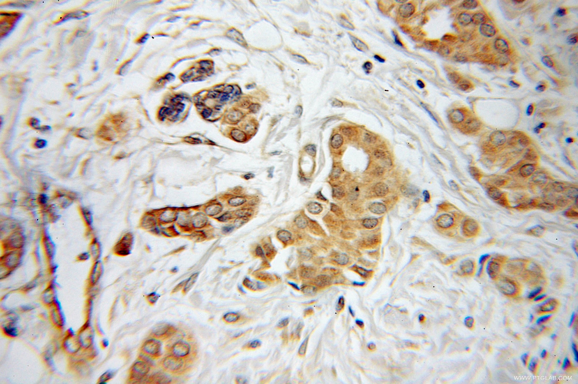 Immunohistochemistry (IHC) staining of human breast cancer tissue using INVS Polyclonal antibody (10585-1-AP)