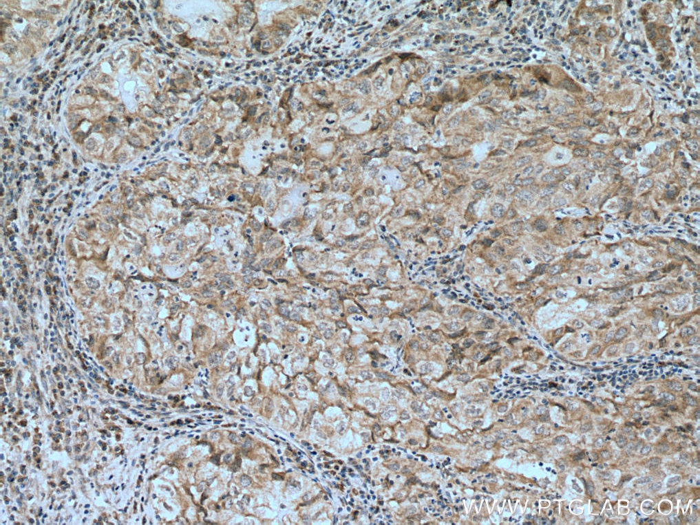 Immunohistochemistry (IHC) staining of human lung cancer tissue using IP6K1 Polyclonal antibody (12057-2-AP)