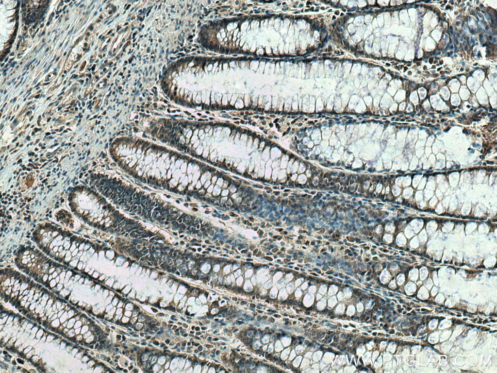 Immunohistochemistry (IHC) staining of human colon cancer tissue using IP6K1 Polyclonal antibody (12057-2-AP)