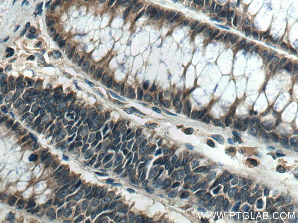 Immunohistochemistry (IHC) staining of human colon cancer tissue using IP6K1 Polyclonal antibody (12057-2-AP)