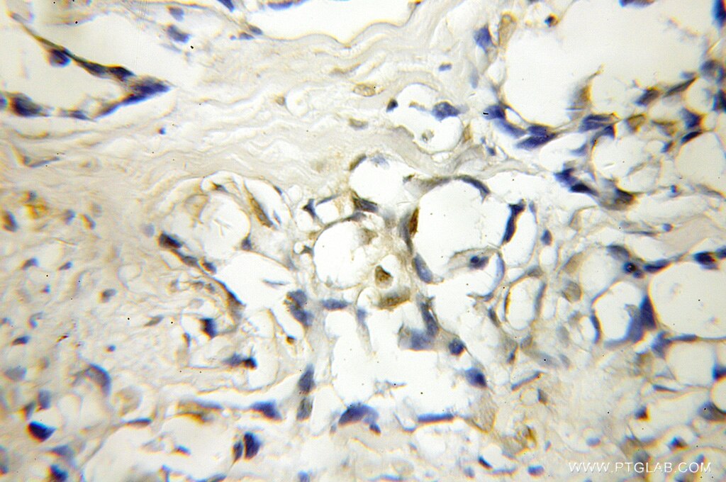 Immunohistochemistry (IHC) staining of human lung cancer tissue using IP6K1 Polyclonal antibody (12057-2-AP)
