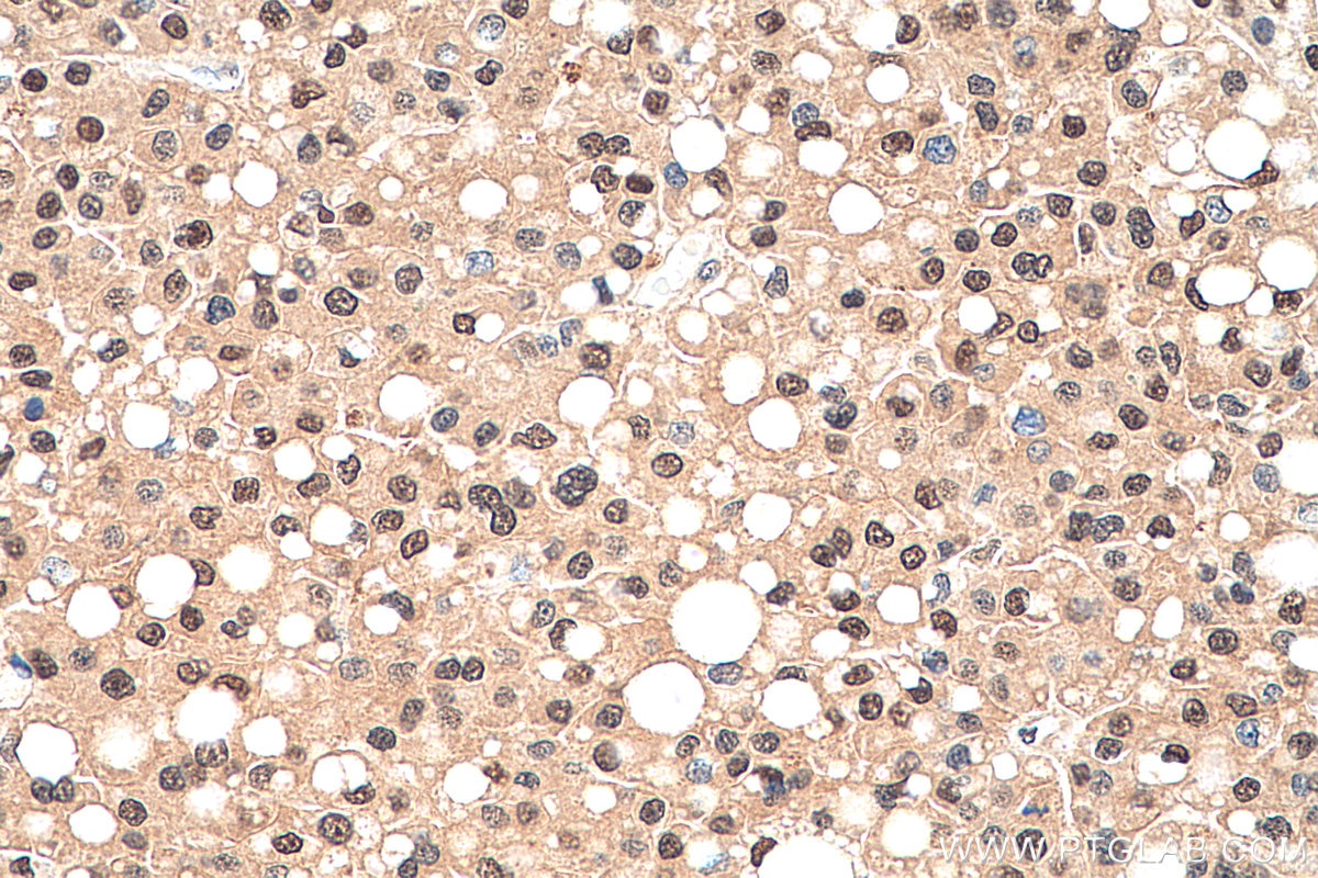 Immunohistochemistry (IHC) staining of human liver cancer tissue using IP6K2 Polyclonal antibody (13155-1-AP)