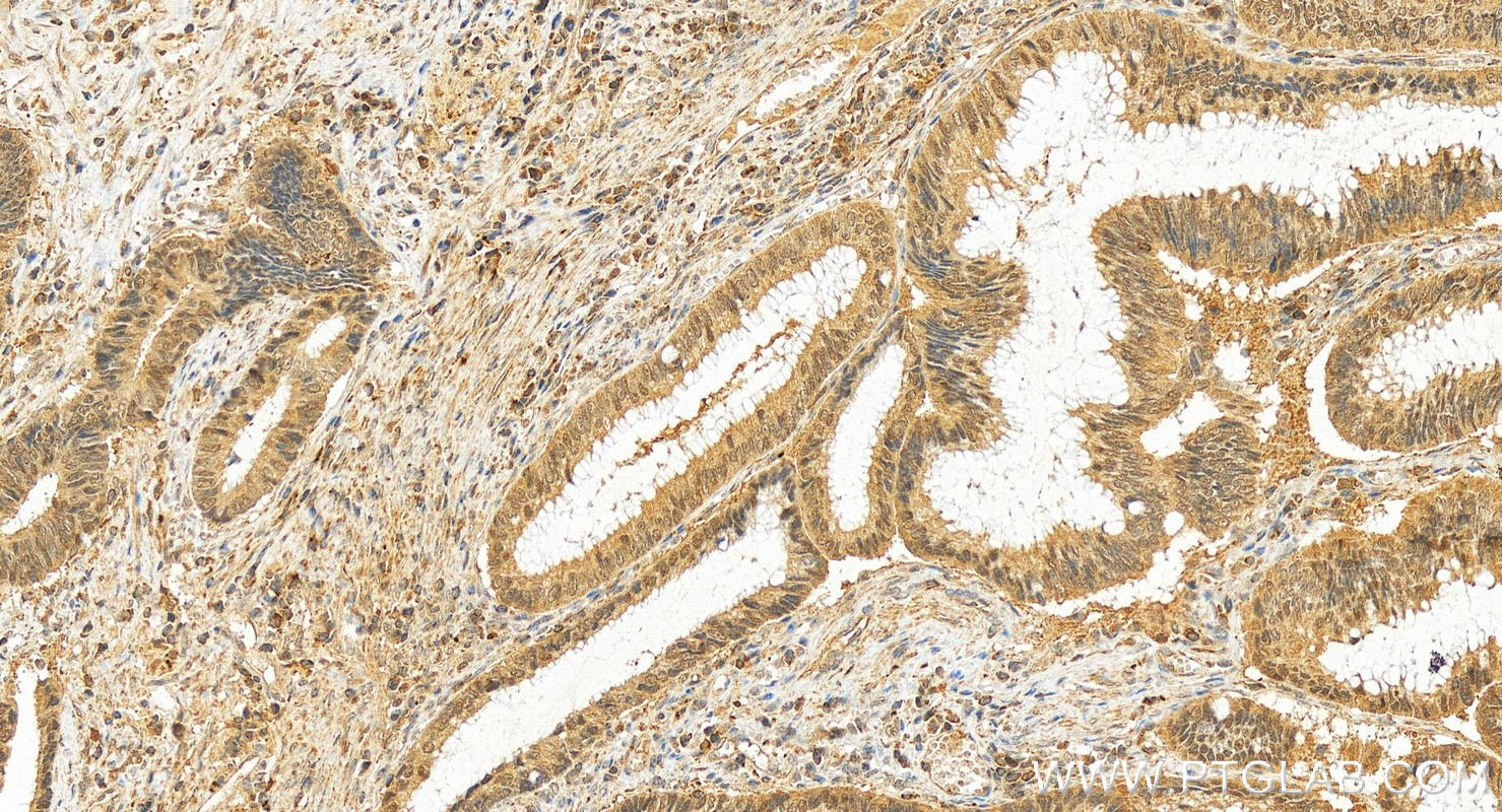 Immunohistochemistry (IHC) staining of human colon cancer tissue using IPO11 Polyclonal antibody (14403-1-AP)