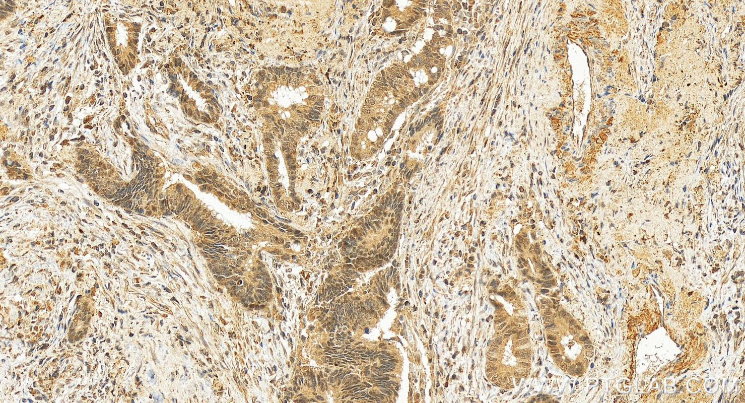 Immunohistochemistry (IHC) staining of human colon cancer tissue using IPO11 Polyclonal antibody (14403-1-AP)