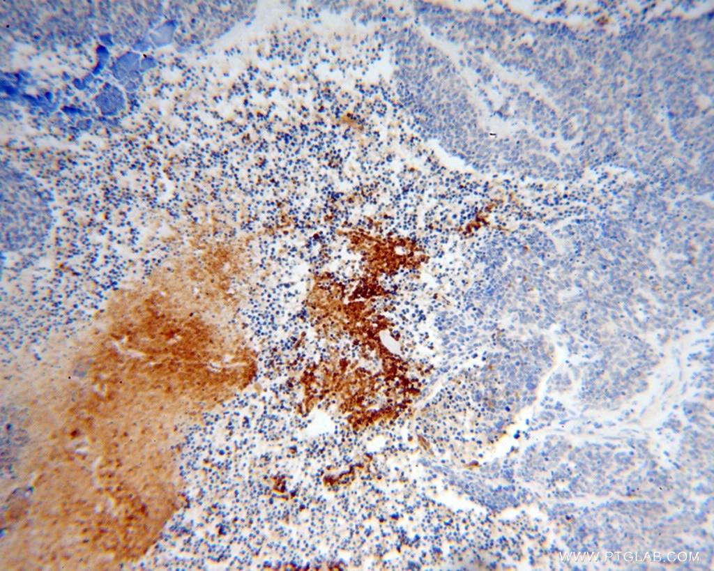 Immunohistochemistry (IHC) staining of human lung cancer tissue using IPO11 Polyclonal antibody (14403-1-AP)