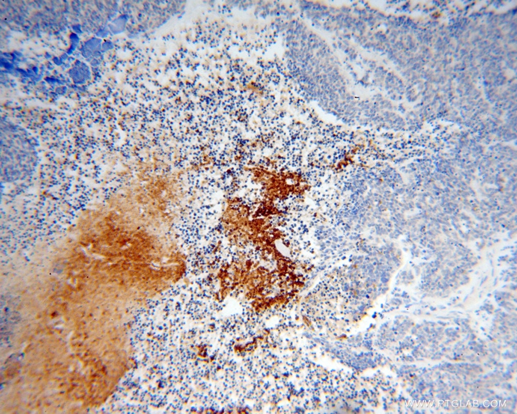 IHC staining of human lung cancer using 14403-1-AP