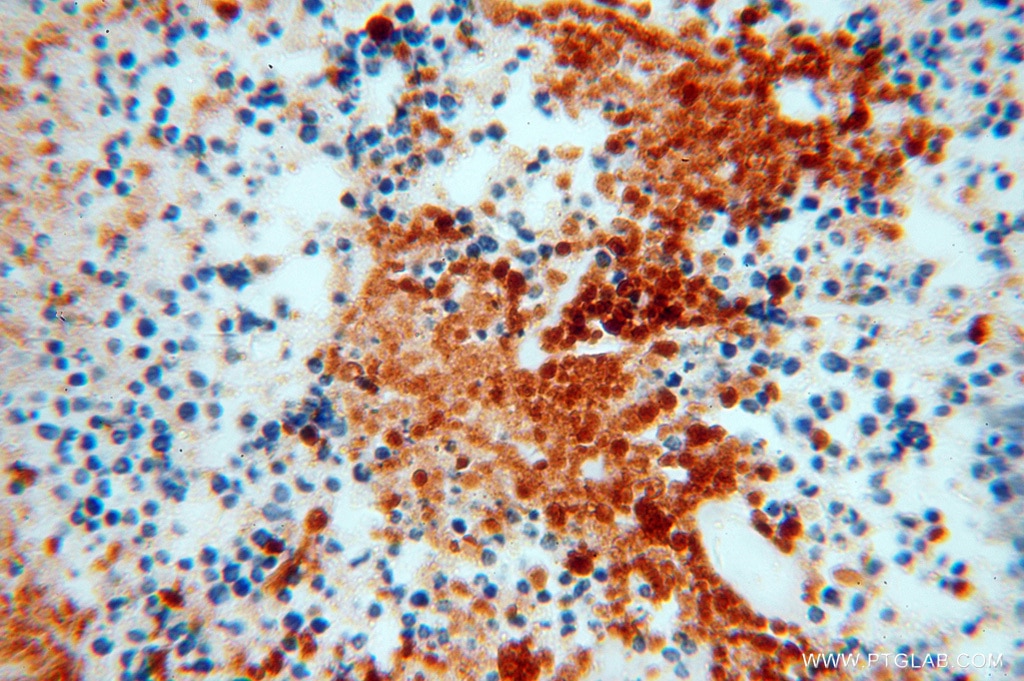 IHC staining of human lung cancer using 14403-1-AP