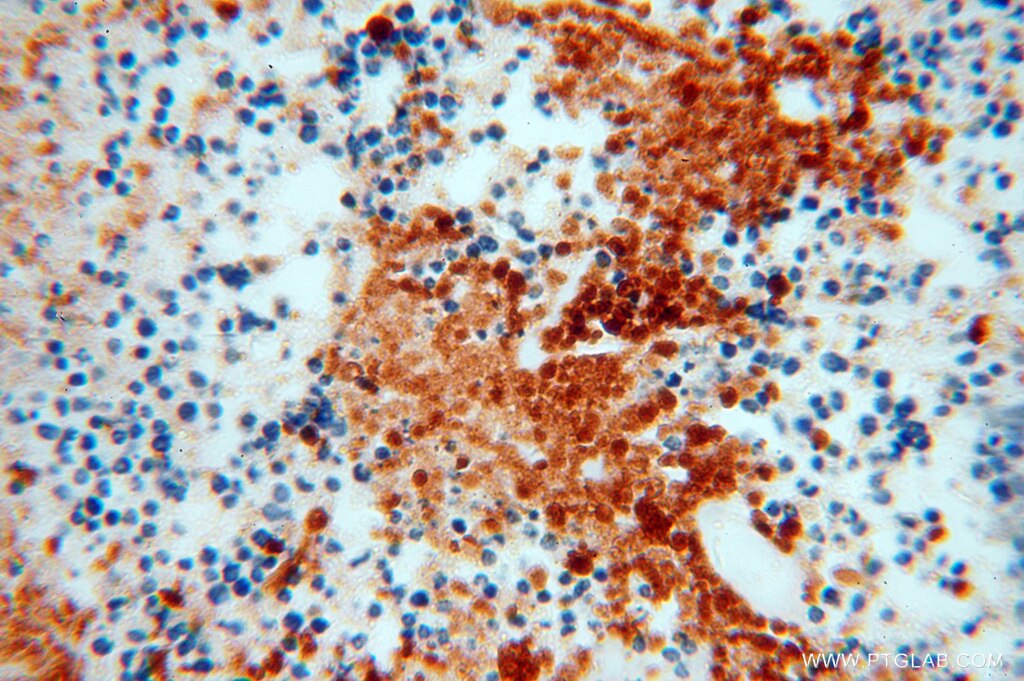 Immunohistochemistry (IHC) staining of human lung cancer tissue using IPO11 Polyclonal antibody (14403-1-AP)