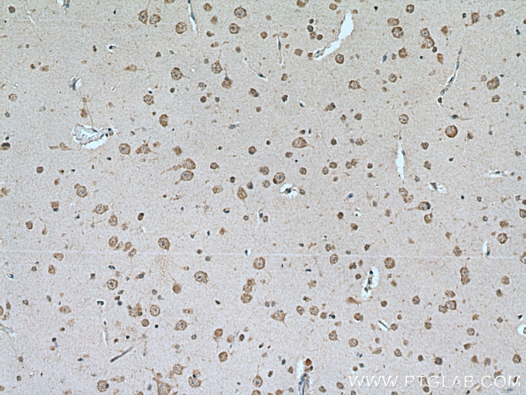 Immunohistochemistry (IHC) staining of human gliomas tissue using IPO13 Polyclonal antibody (11696-2-AP)