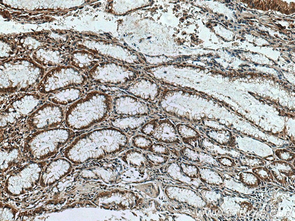 Immunohistochemistry (IHC) staining of human stomach cancer tissue using IPO4 Polyclonal antibody (11679-1-AP)