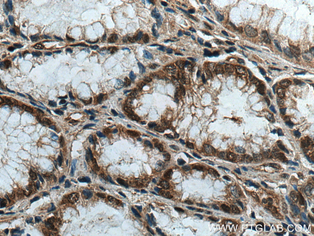 Immunohistochemistry (IHC) staining of human stomach cancer tissue using IPO4 Polyclonal antibody (11679-1-AP)