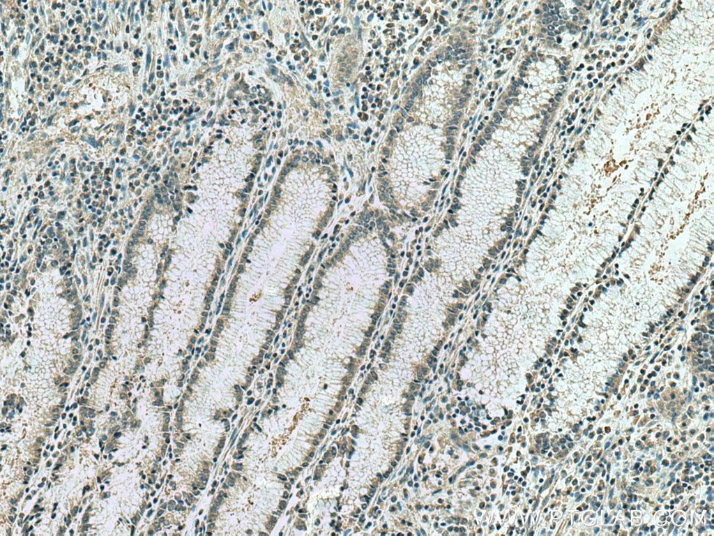 Immunohistochemistry (IHC) staining of human stomach cancer tissue using IPO4 Monoclonal antibody (67549-1-Ig)