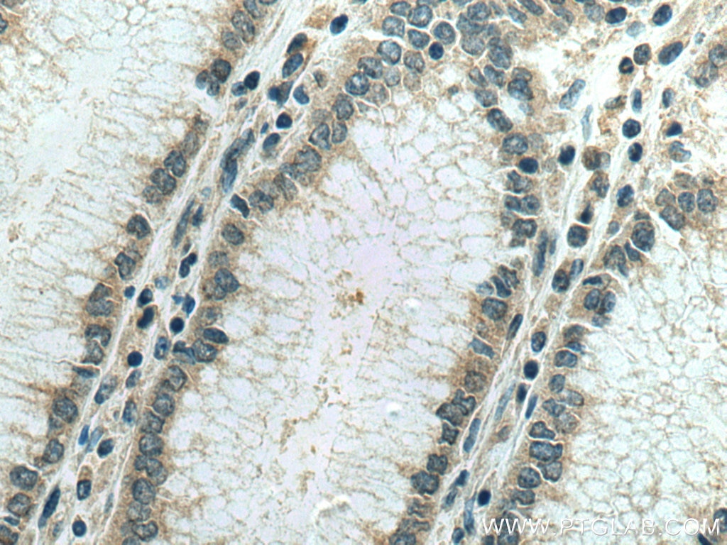 Immunohistochemistry (IHC) staining of human stomach cancer tissue using IPO4 Monoclonal antibody (67549-1-Ig)