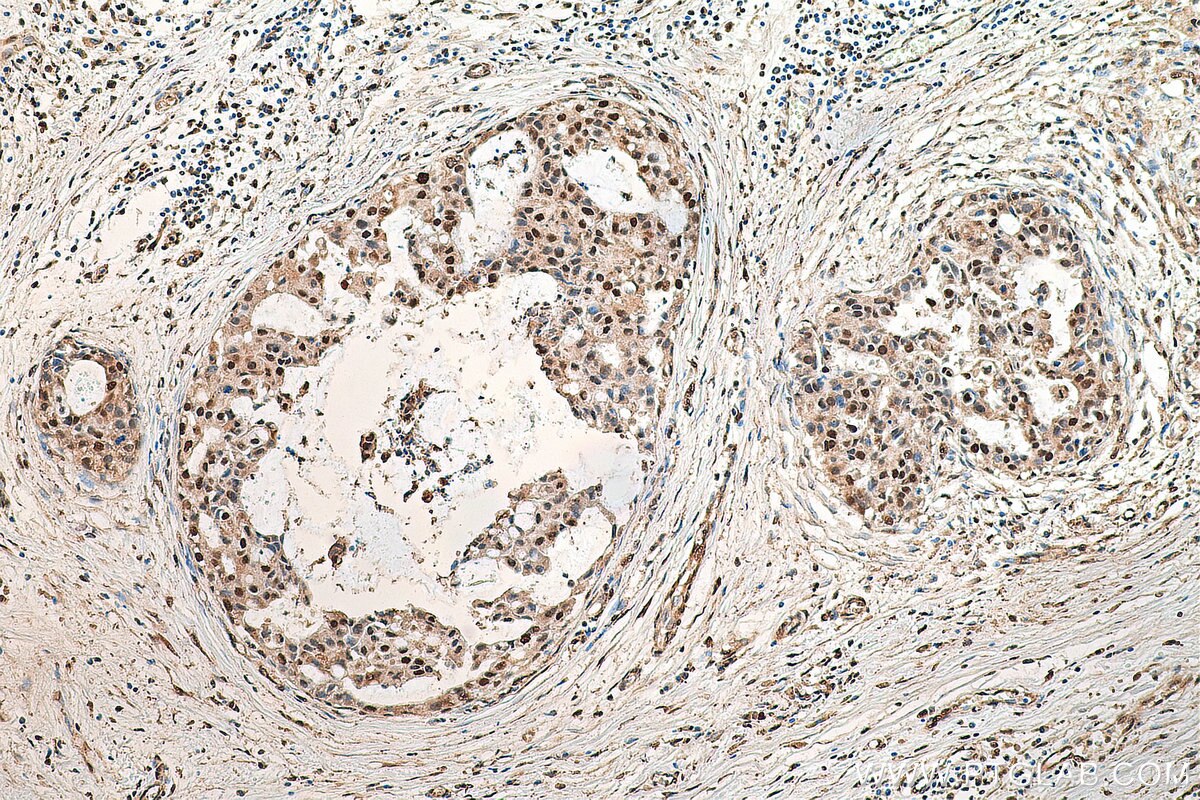 IHC staining of human breast cancer using 28289-1-AP