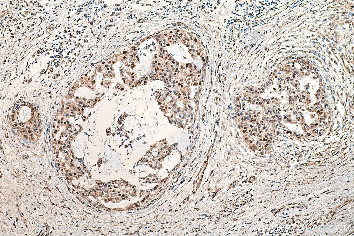 Immunohistochemistry (IHC) staining of human breast cancer tissue using IPO7 Polyclonal antibody (28289-1-AP)