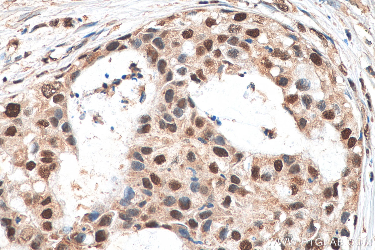 Immunohistochemistry (IHC) staining of human breast cancer tissue using IPO7 Polyclonal antibody (28289-1-AP)