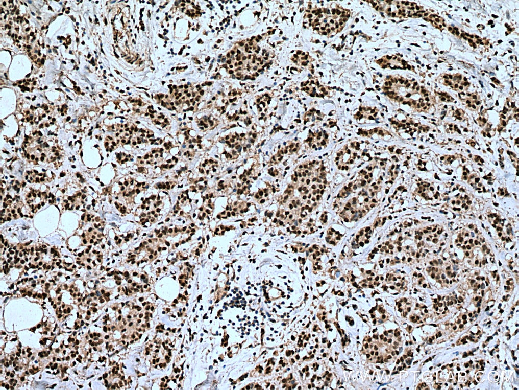 Immunohistochemistry (IHC) staining of human breast cancer tissue using IPO7 Monoclonal antibody (67525-1-Ig)