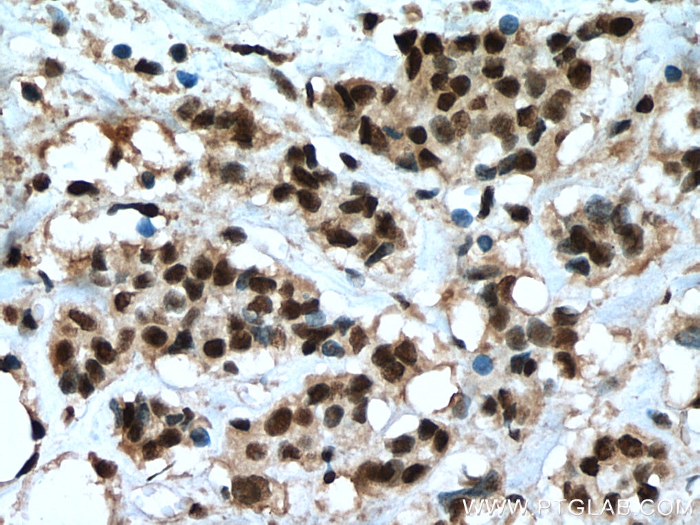Immunohistochemistry (IHC) staining of human breast cancer tissue using IPO7 Monoclonal antibody (67525-1-Ig)