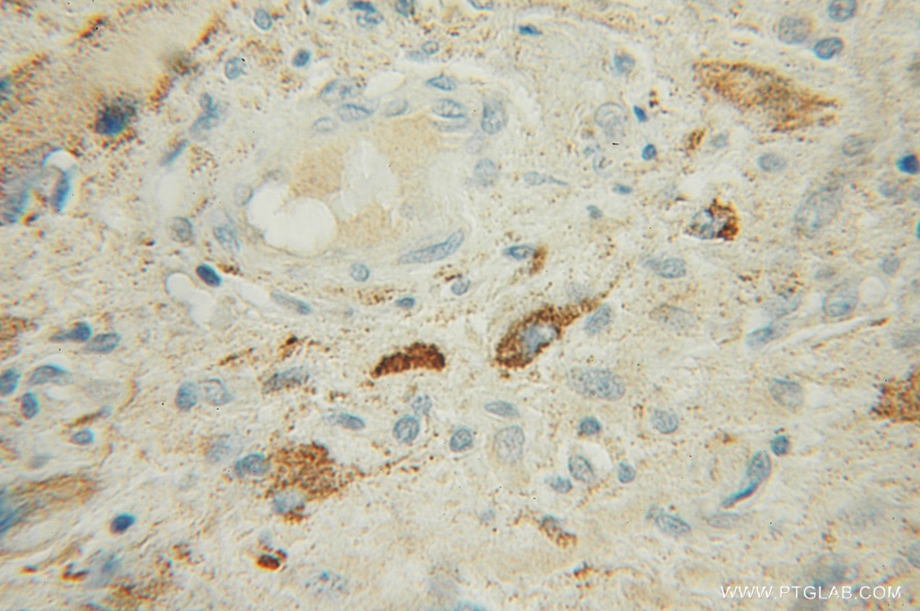 Immunohistochemistry (IHC) staining of human gliomas tissue using IPPK Polyclonal antibody (12603-1-AP)