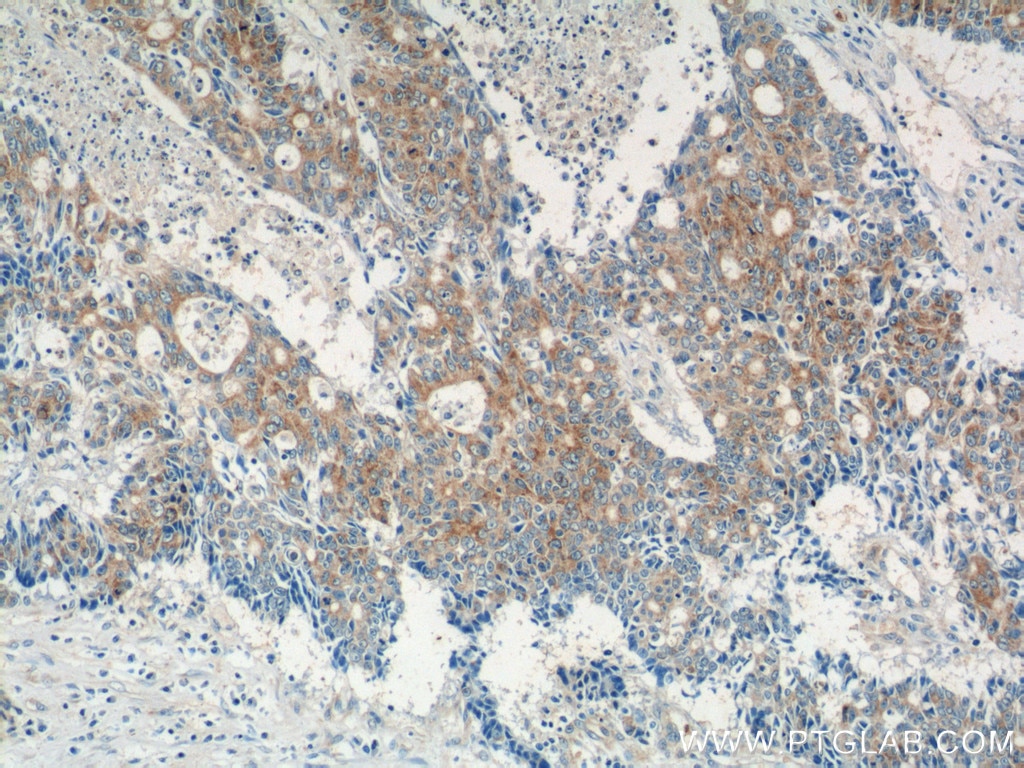 Immunohistochemistry (IHC) staining of human colon cancer tissue using IQCK Polyclonal antibody (25740-1-AP)