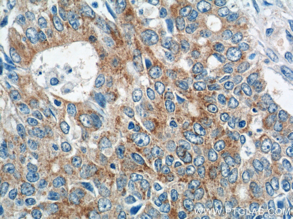 Immunohistochemistry (IHC) staining of human colon cancer tissue using IQCK Polyclonal antibody (25740-1-AP)