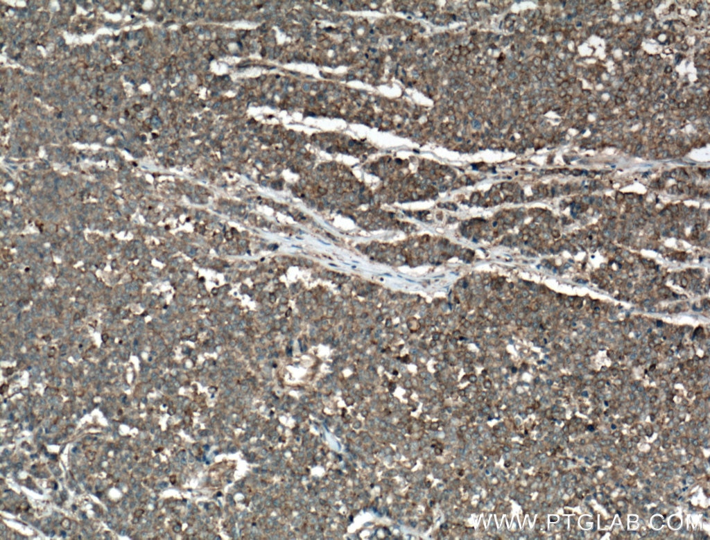 Immunohistochemistry (IHC) staining of human colon cancer tissue using IQGAP1 Polyclonal antibody (22167-1-AP)