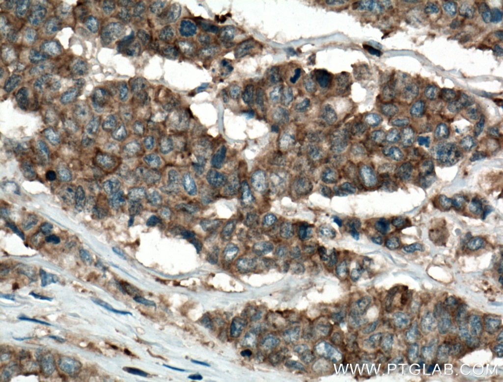 Immunohistochemistry (IHC) staining of human colon cancer tissue using IQGAP1 Polyclonal antibody (22167-1-AP)