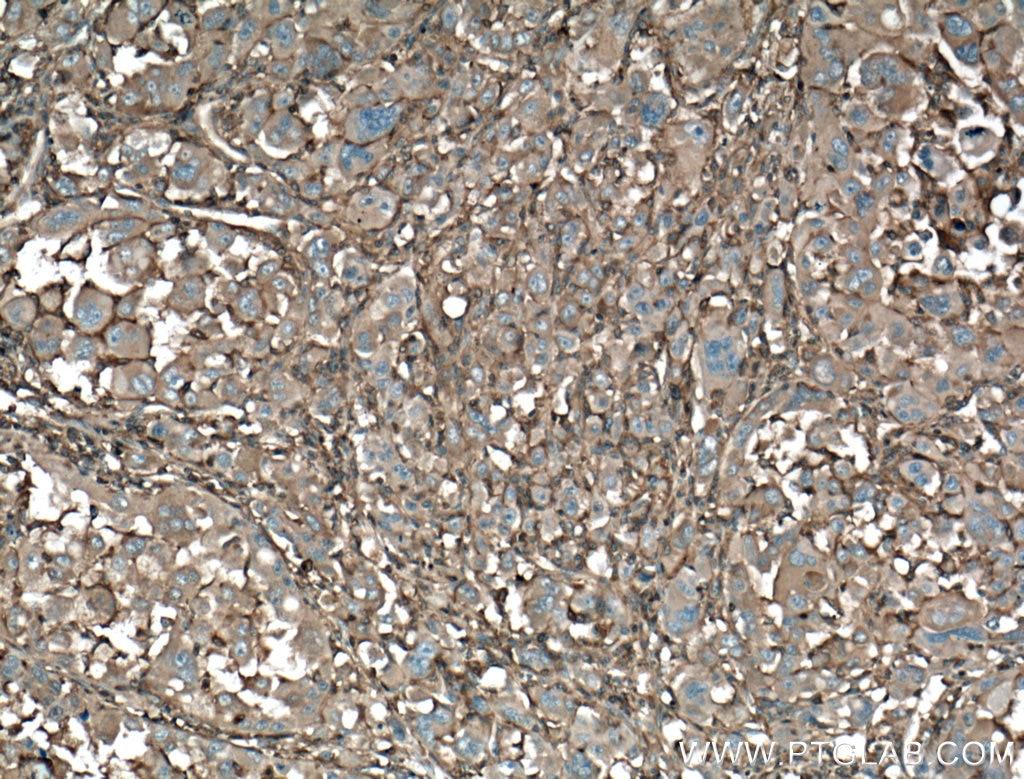IHC staining of human liver cancer using 22167-1-AP