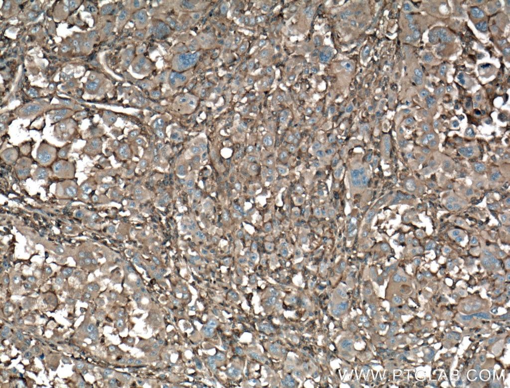 Immunohistochemistry (IHC) staining of human liver cancer tissue using IQGAP1 Polyclonal antibody (22167-1-AP)