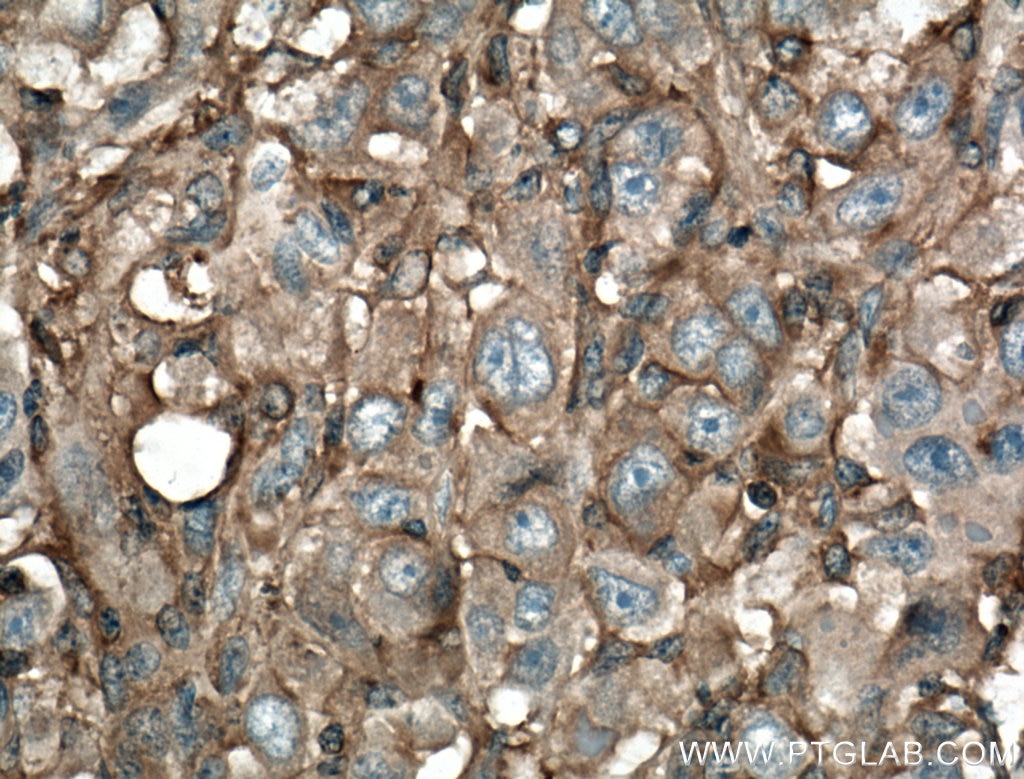 Immunohistochemistry (IHC) staining of human liver cancer tissue using IQGAP1 Polyclonal antibody (22167-1-AP)