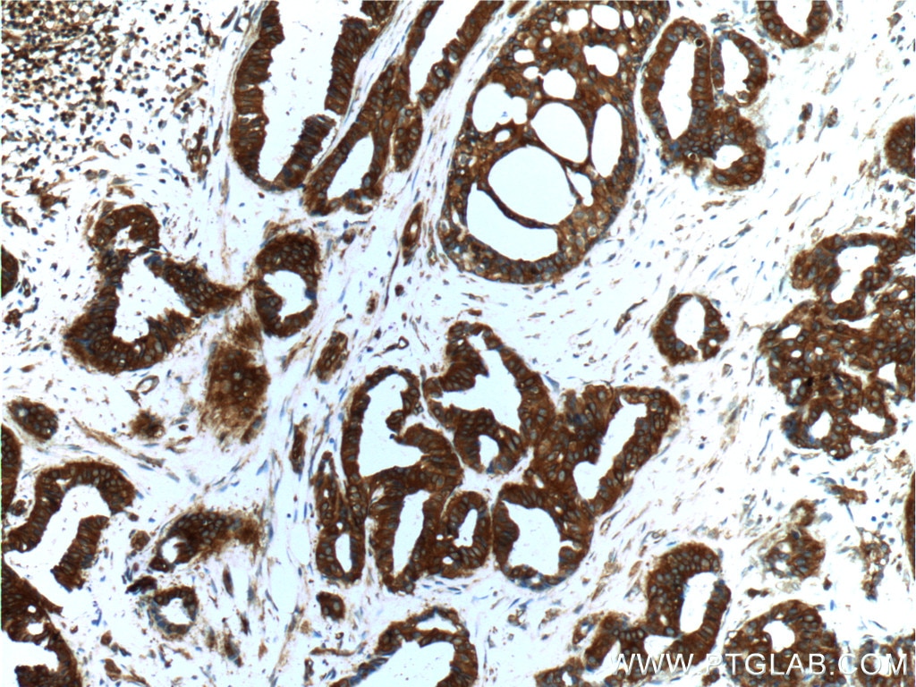 Immunohistochemistry (IHC) staining of human breast cancer tissue using IQGAP1 Polyclonal antibody (22167-1-AP)
