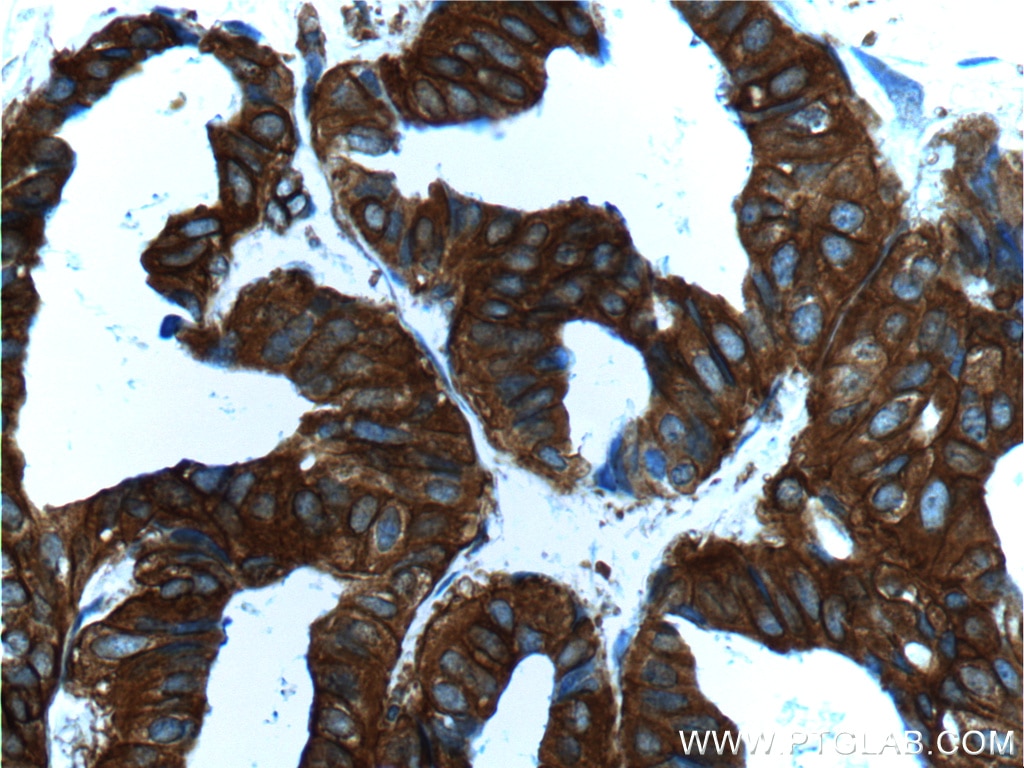 Immunohistochemistry (IHC) staining of human breast cancer tissue using IQGAP1 Polyclonal antibody (22167-1-AP)