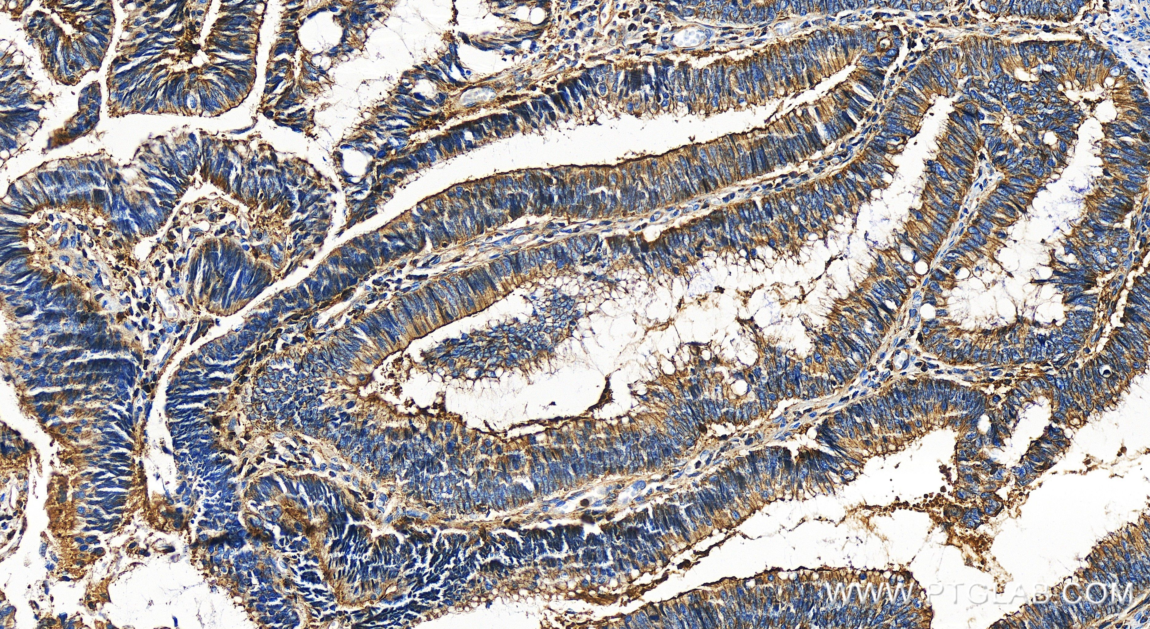 Immunohistochemistry (IHC) staining of human colon cancer tissue using IQGAP1 Recombinant antibody (85651-1-RR)