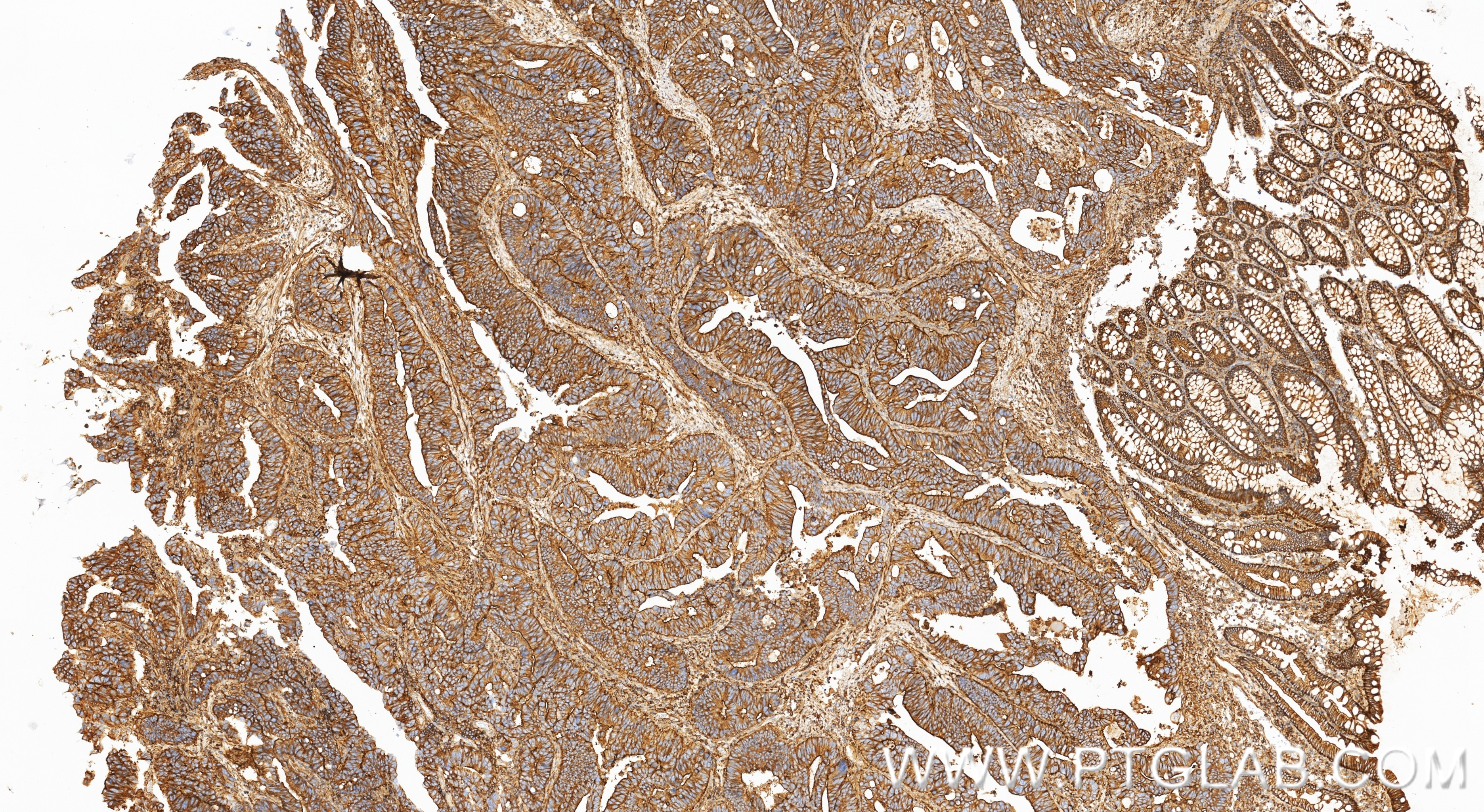 Immunohistochemistry (IHC) staining of human colon cancer tissue using IQGAP1 Recombinant monoclonal antibody (85651-1-RR)