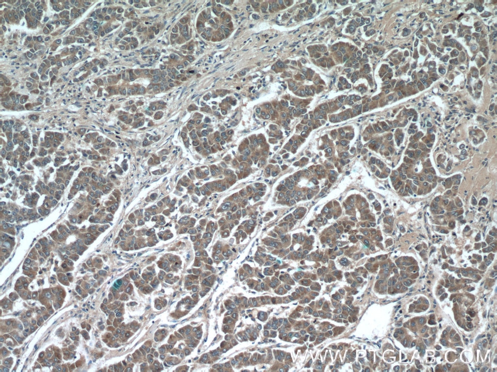 Immunohistochemistry (IHC) staining of human liver cancer tissue using IQGAP2 Polyclonal antibody (55189-1-AP)