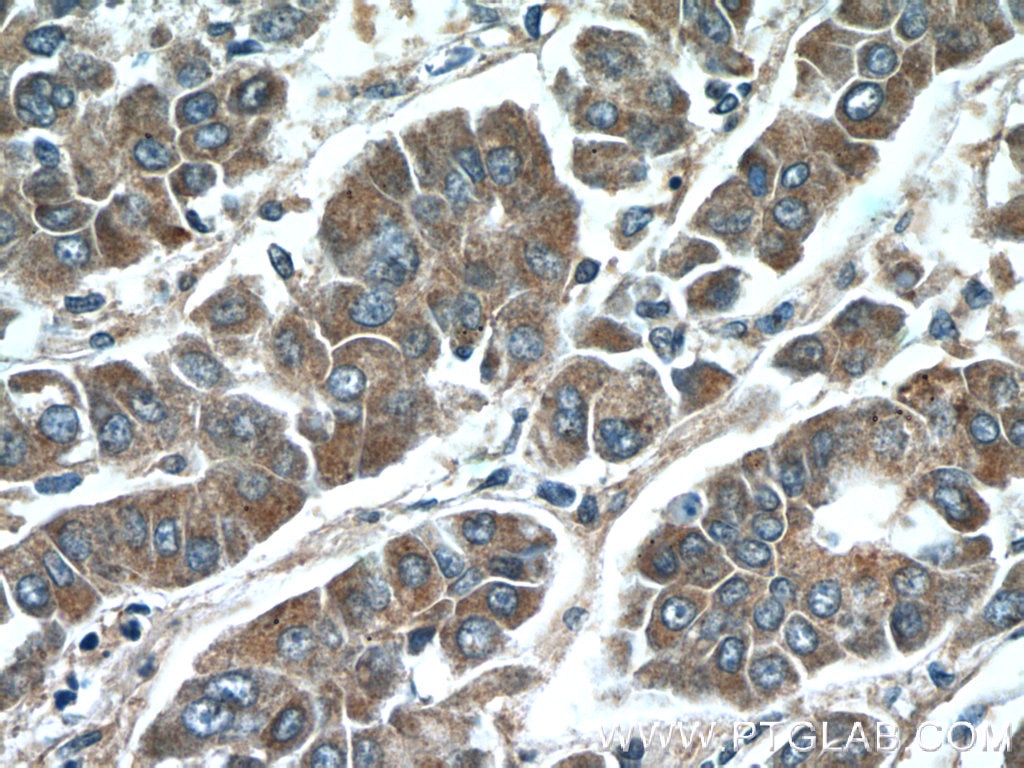 Immunohistochemistry (IHC) staining of human liver cancer tissue using IQGAP2 Polyclonal antibody (55189-1-AP)